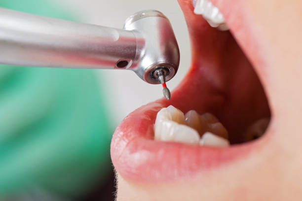 Best Emergency Wisdom Tooth Extraction in Wheaton, MD